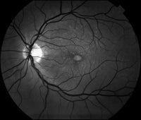 Cámara Retiniana No Midriática Topcon TRC-NW8 Reacondicionado | Fondo De Ojo | Servemex México